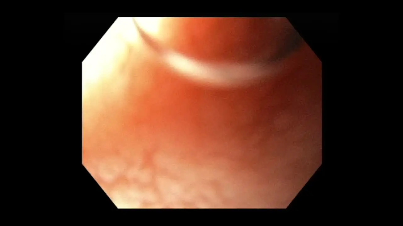 Anatomy Of An Oesophagus During Gastroscopy Tract macro