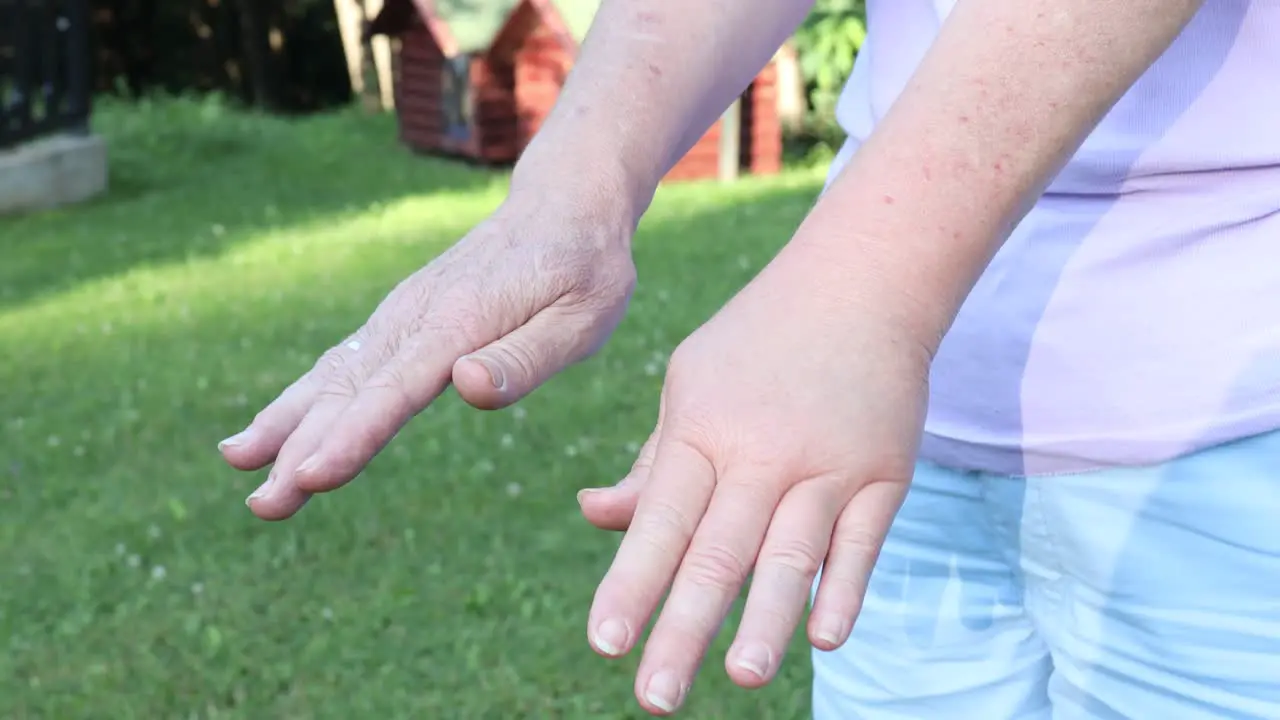 Comparison of two female hands stung by bee or wasp