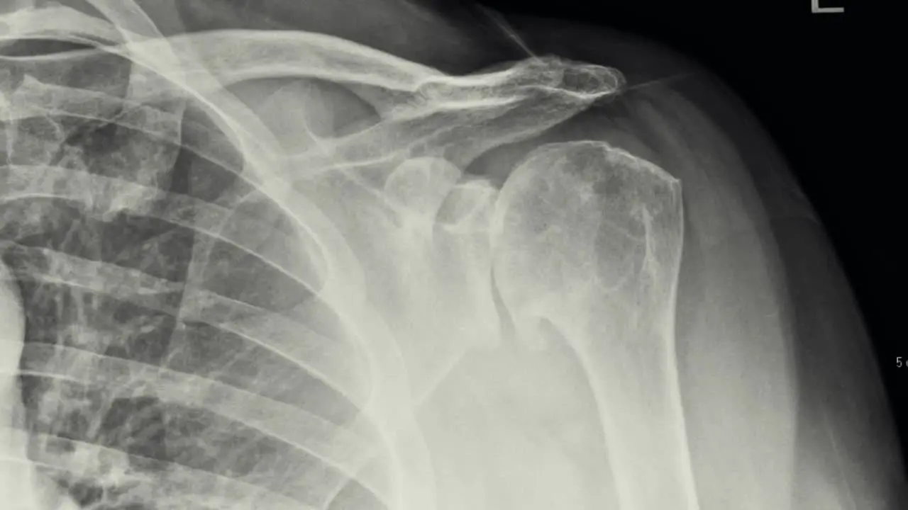 X Ray showing shoulder arthritis requiring shoulder replacement surgery