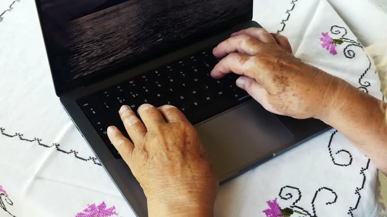 Woman with vitiligo on her hands working on the computer