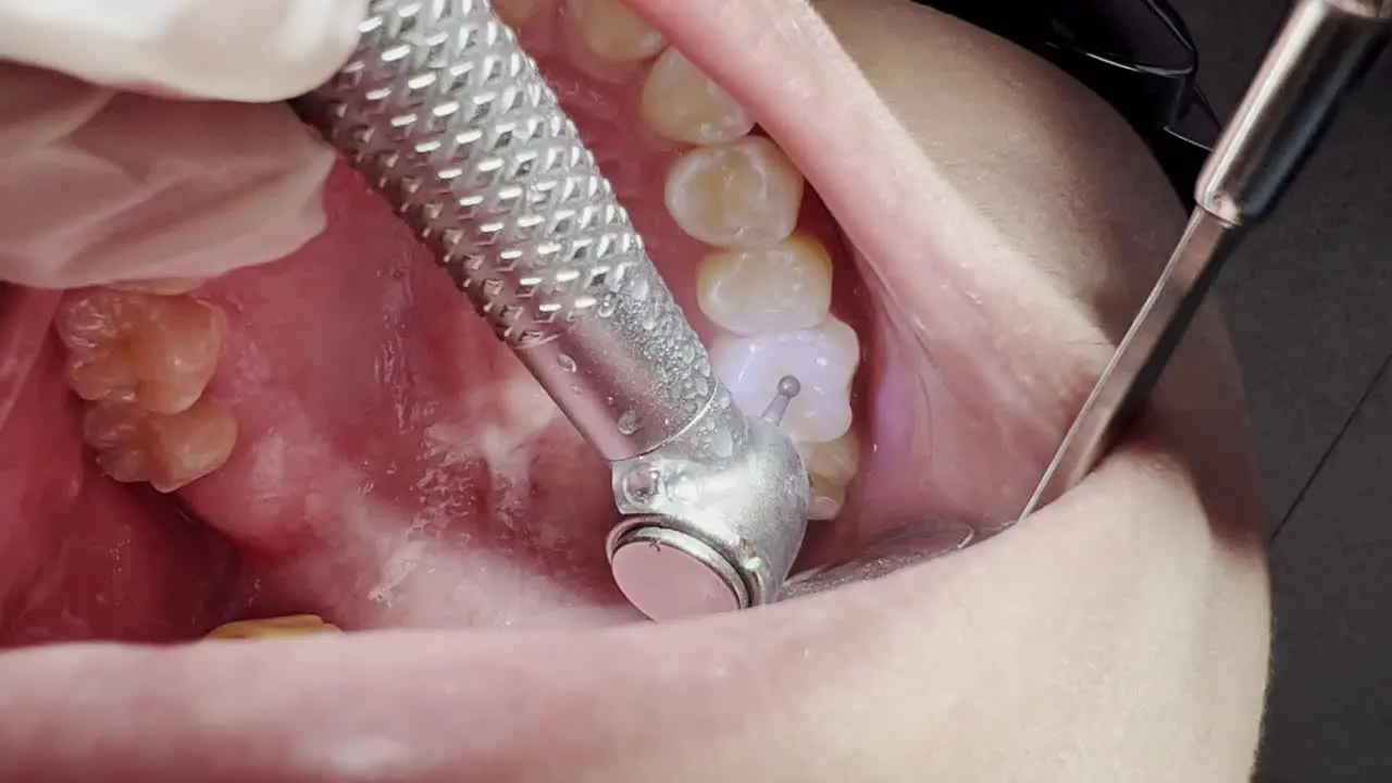 Close up shot of a dentist drilling a tooth to remove tooth cavity