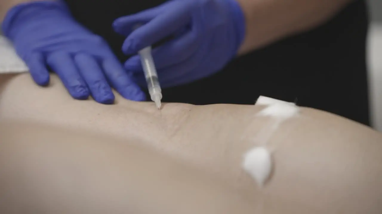 Dermatologist Wearing Gloves Performing Sclerotherapy Procedure Inside The Clinic