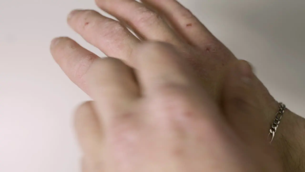 Person With Hand Disease Scratching Health Problems With Skin Close Up Shot