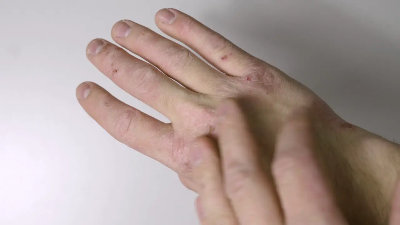 Caucasian Hands With Psoriasis Or Eczema Sickness Hand Skin Disease Concept Close Up Shot