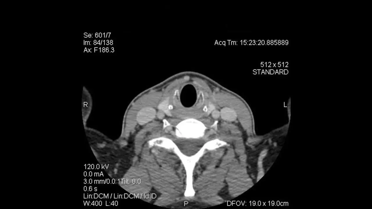 Axial Tomography CT Scan layers from top of head to mid-thoracic