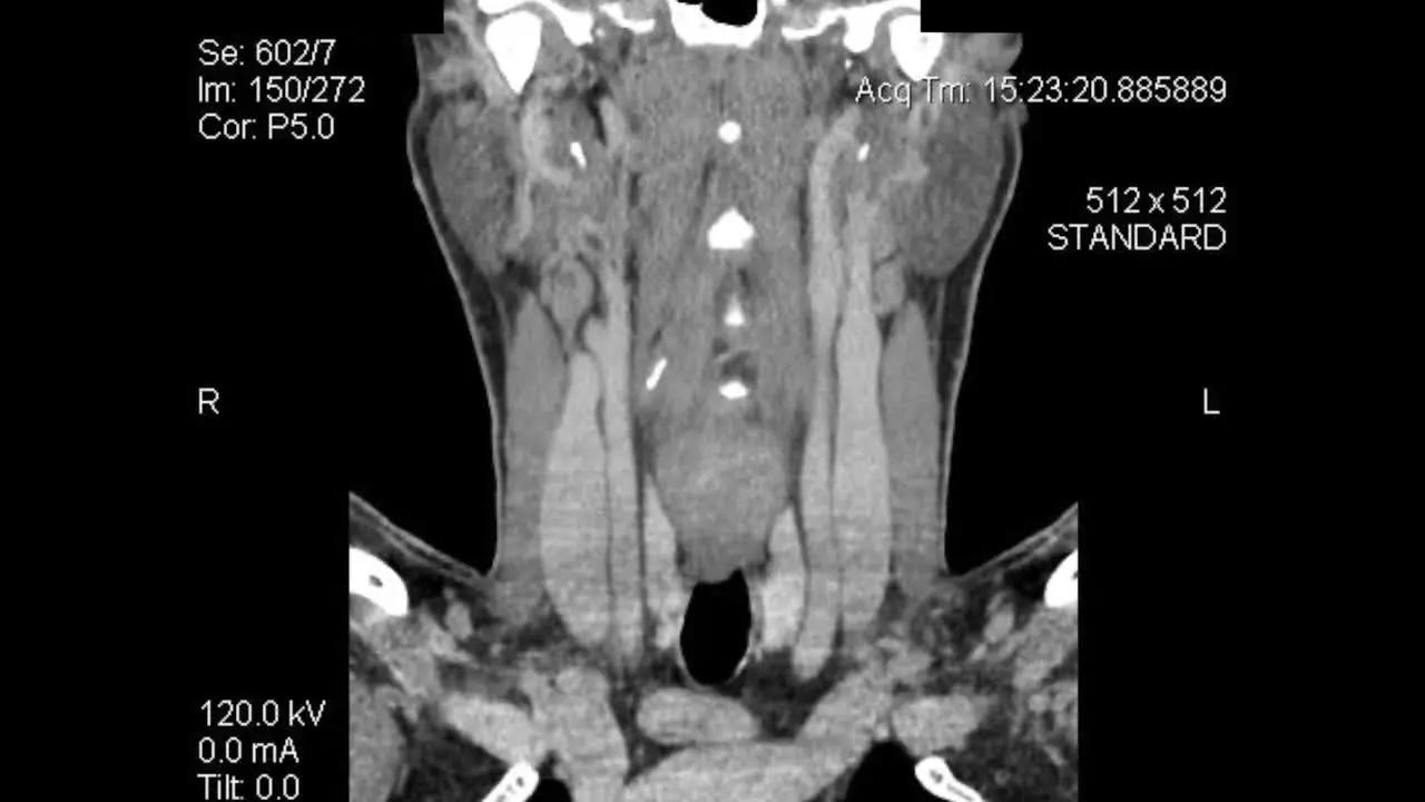 Front Coronal plane tomography CT scan layers of lower face and neck