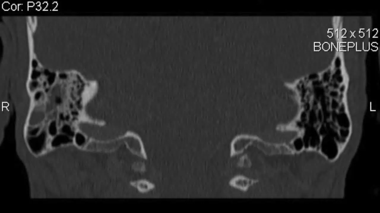 Coronal CT Computed Tomography scan layers of lower cranium and neck