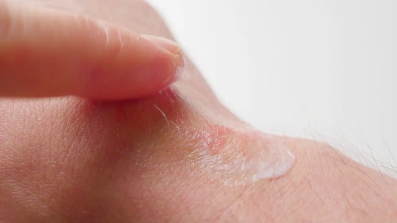 Man applying moisturizing cream on his irritated skin