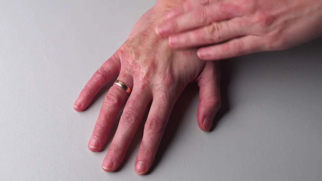 Woman with red dry and itchy skin apply hand cream on psoriasis allergic spot