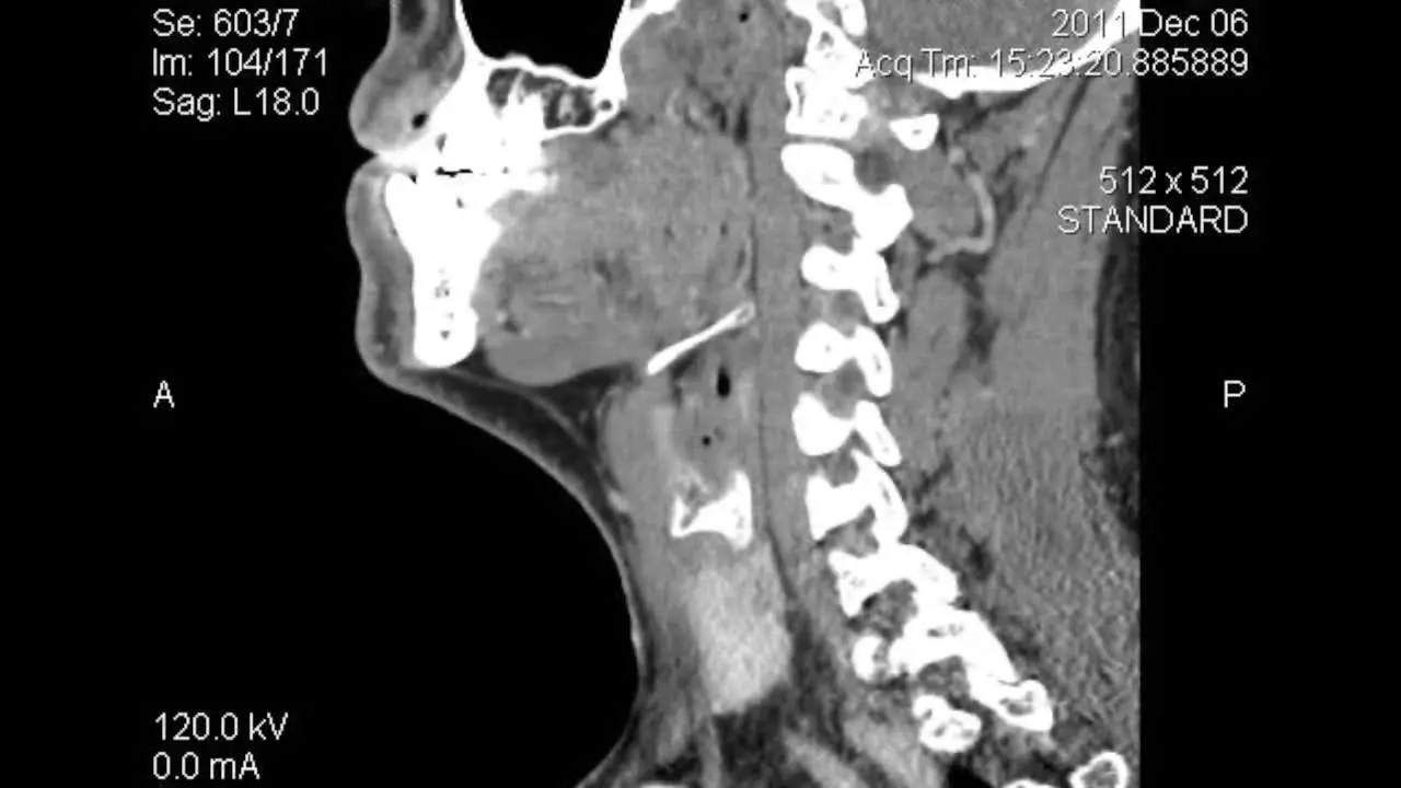 Sagittal plane tomography CT scan layers of lower face and neck