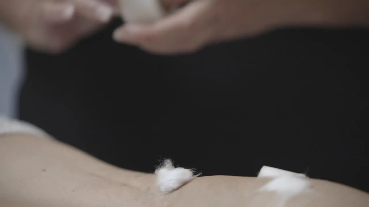 Doctor's Hands Holding Micropore Tape Next To A Patient During Sclerotherapy Treatment