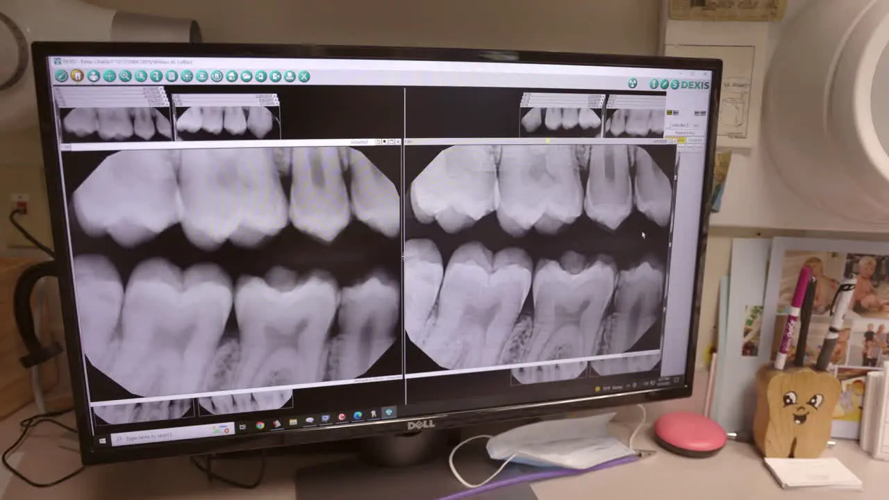 XRay on computer a screen of patients teeth at Dentist office