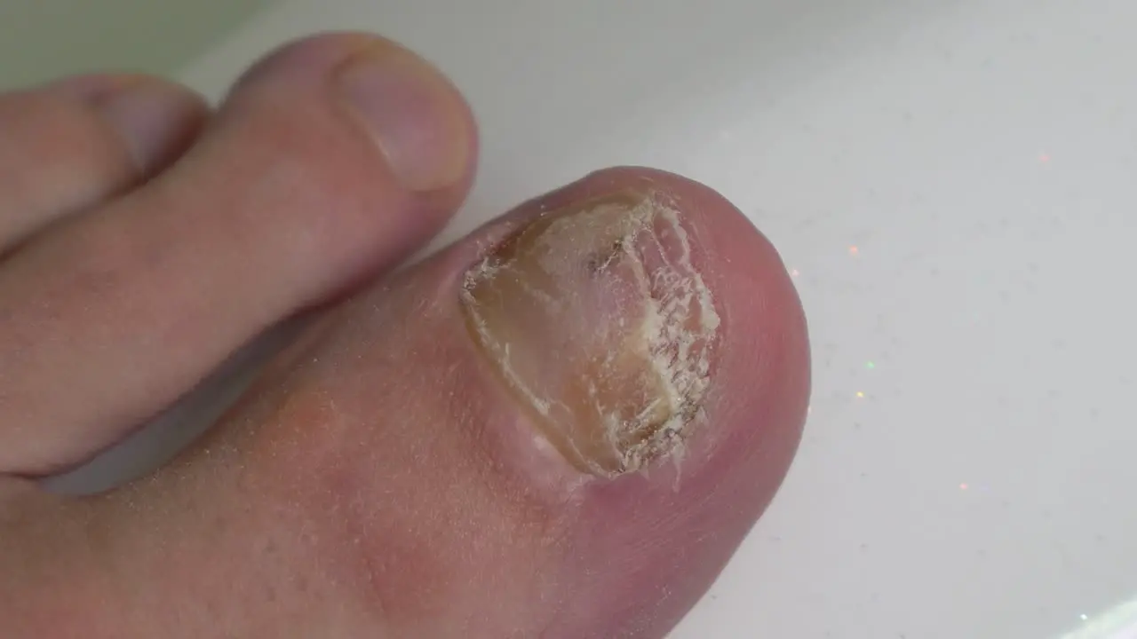 Yellow cracked and discolored toe nail caused by mycosis fingers rub the sore toe close-up