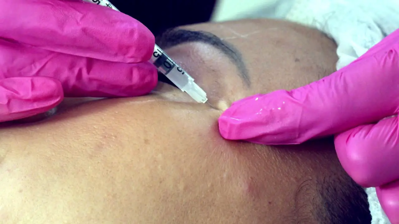 Botox injections to a woman's face close up