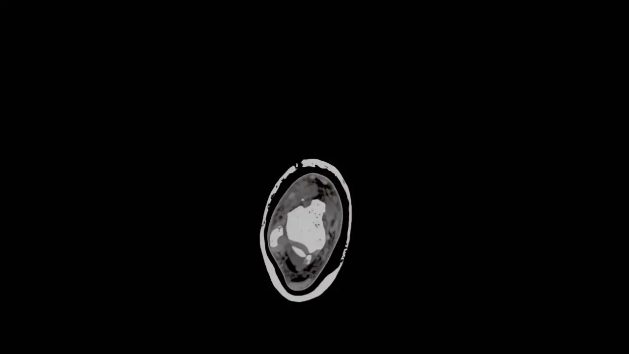 MRI scan of a foot showing multiple small fractures slowly scanning from top to bottom and showing whole foot