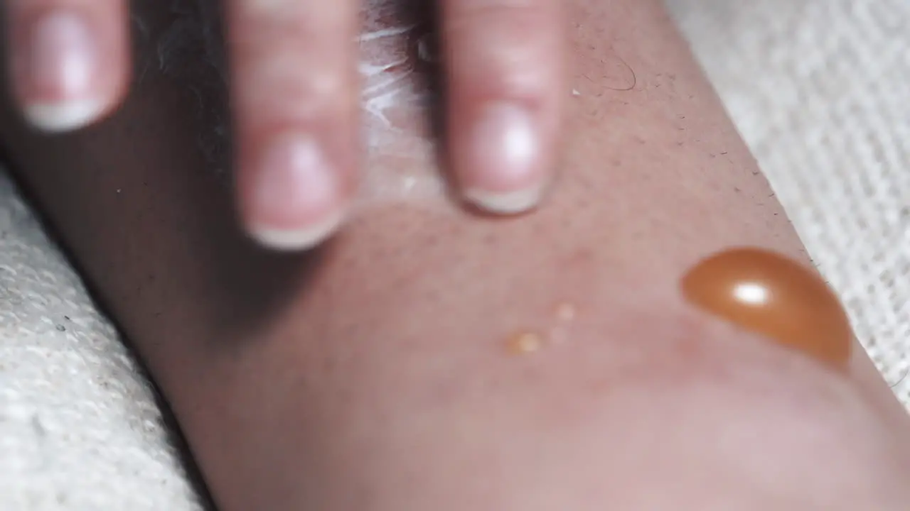 Person Applies Ointment To Infected And Painful Blisters Swollen With Fluid And Pus Discharge