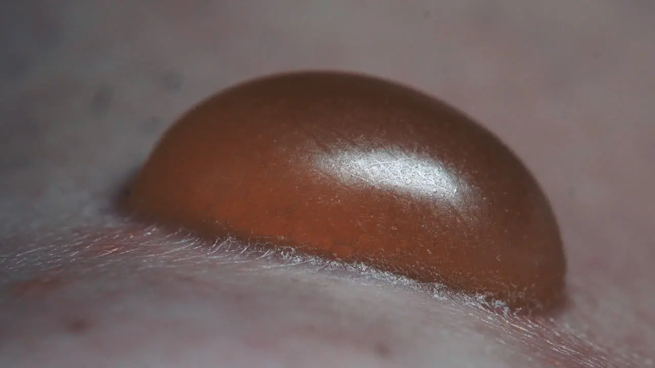 Closeup Of Extreme Painful Blister Infected With Pus Medical Treatment And Dermatologist Patient