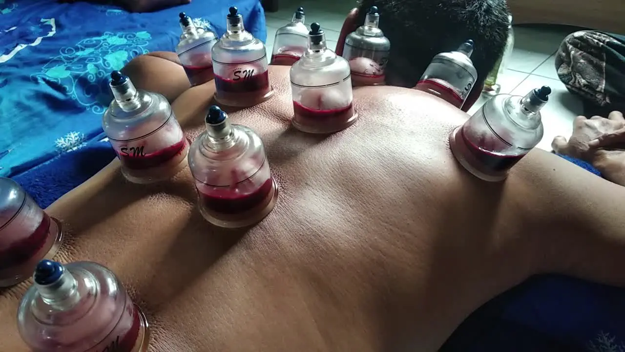 Cupping or Bekam Hijamah is traditional treatment