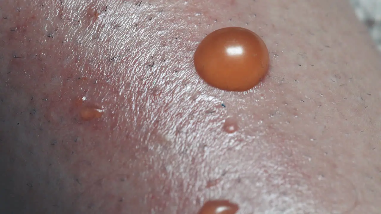 Closeup Of Redness And Painful Sports Surrounding Fluid Filled Blisters On Human Skin