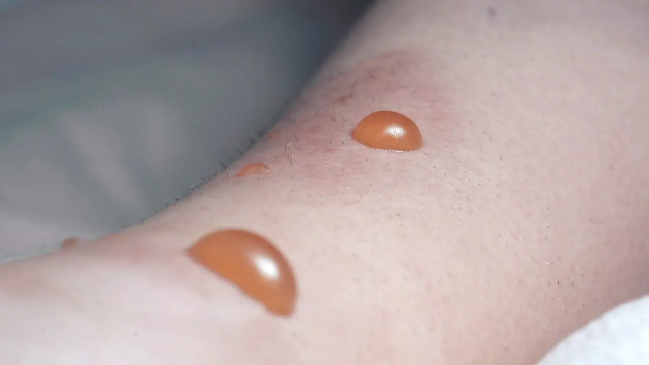 Closeup Of Infected Blisters Swollen With Fluid Requiring Medical Treatment In Hospital