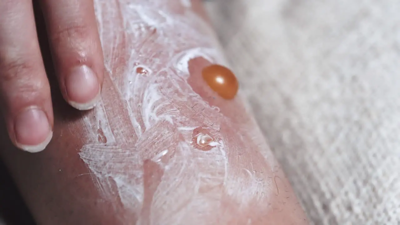 Closeup Of Topical Application Medicine Ointment Applied To Painful Blisters Swollen And Infected