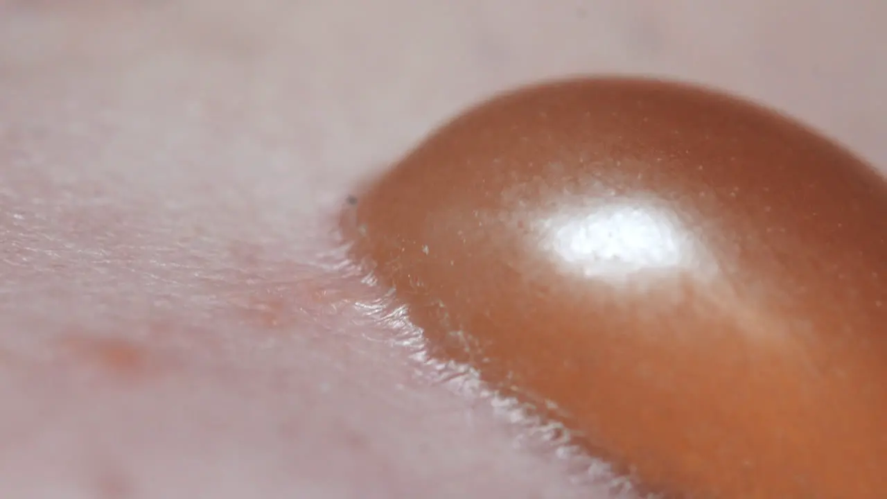 Closeup Of Swollen Blister Filled With Fluid Painful Skin Infection Treated In Hospital