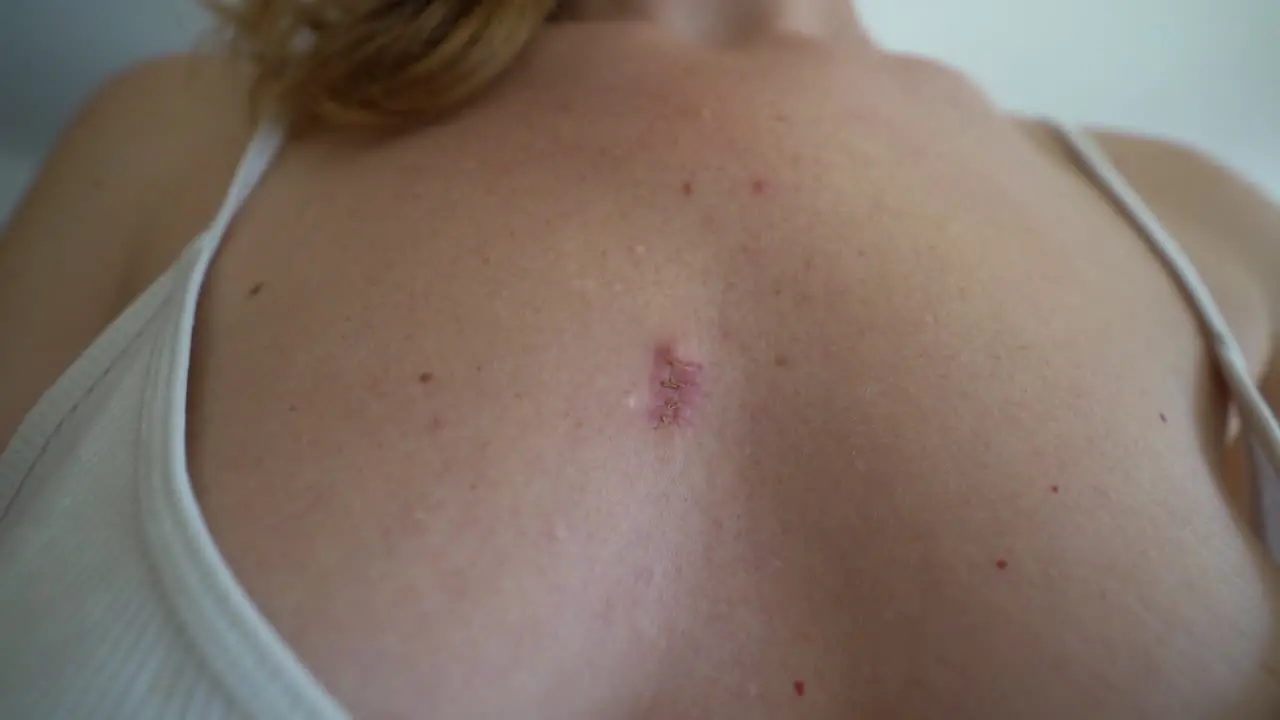 A wound that heals and turns into a scar after removing a cyst on a woman's breast