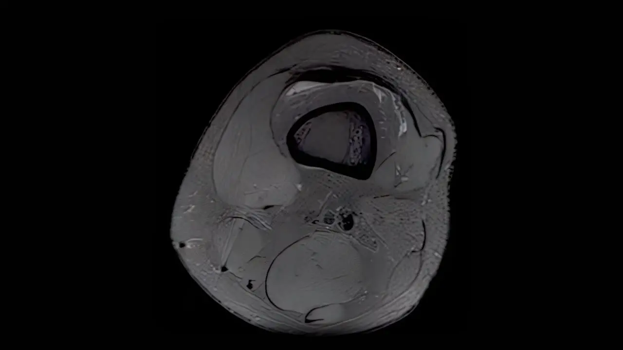 MRI scan of an injured male knee scanning from top to bottom