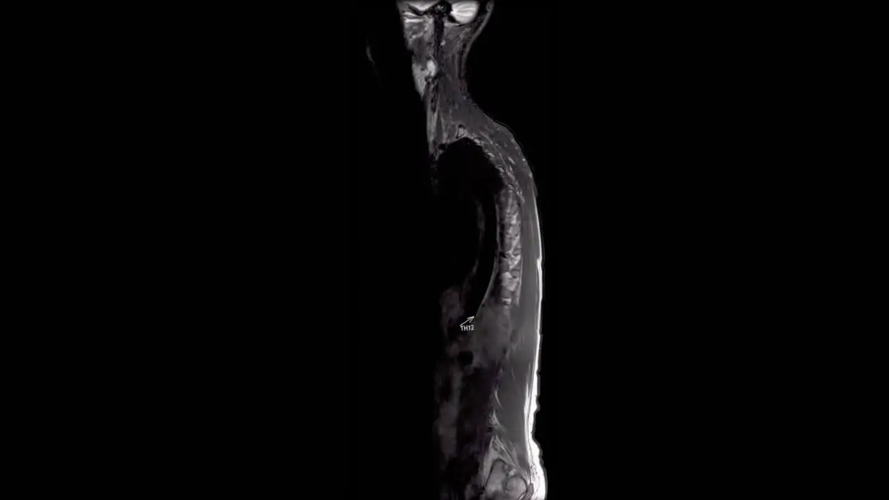 MRI scan of the full spine of a woman going side to side