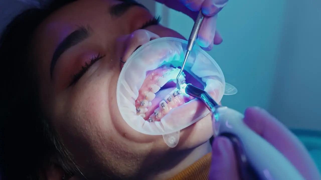 orthodontist bonding braces on teeth by light cure dentistry