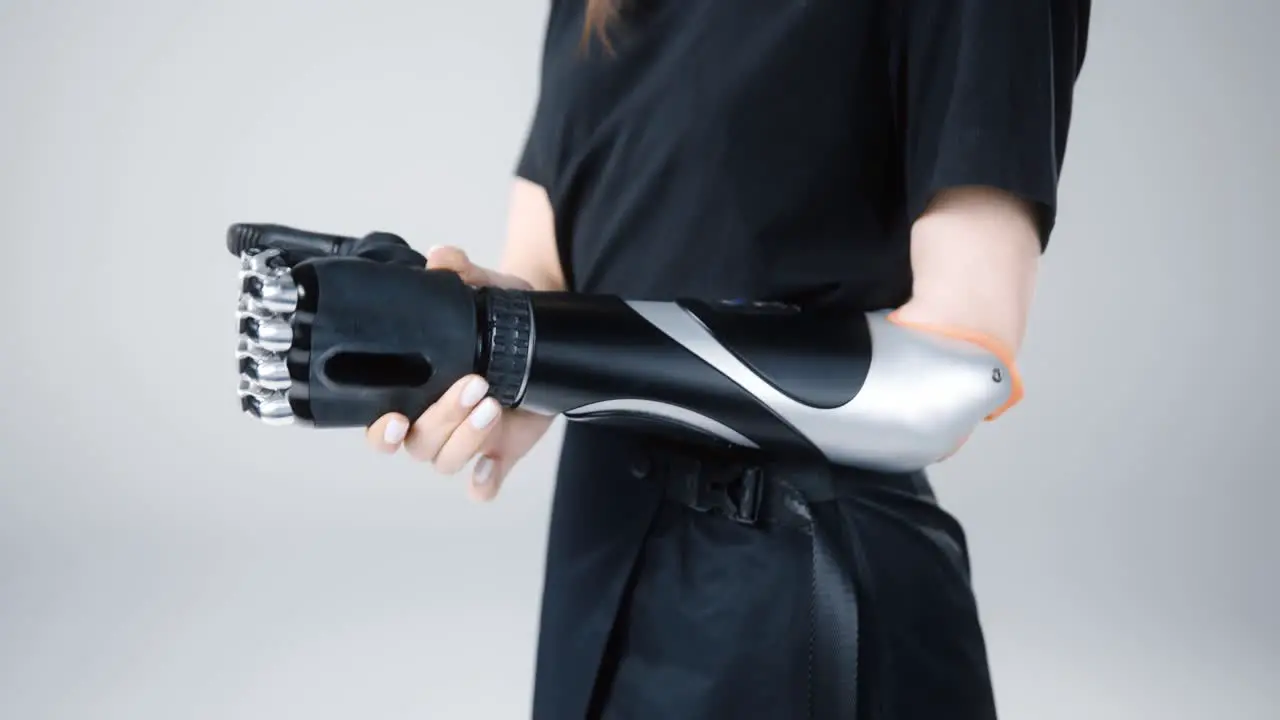 Girl with amputated hand connect Prosthetic artificial upper limb BIONIC forearm