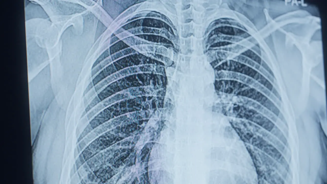 Chest X-ray Interpretation Medical Concept closeup