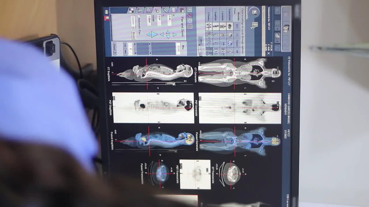 Monitor showing health information of a patient from a clinic which was scanned with a machine known as PET-CT which scans patients with tumors in different parts of the body