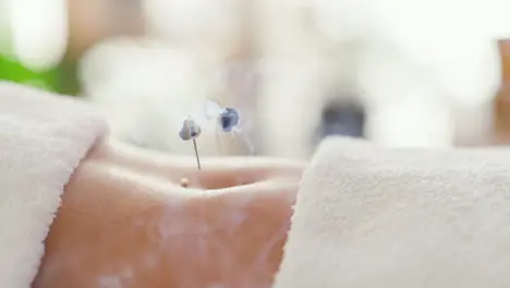 Closeup of a body with acupuncture needles