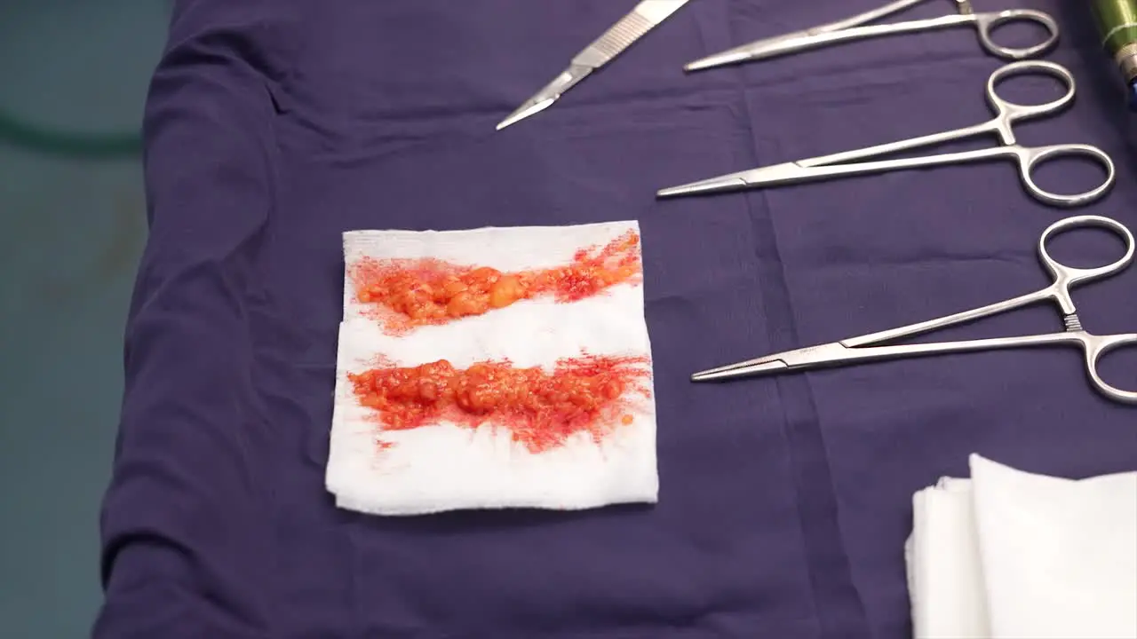 scissors in hospital operating room fat removed during liposuction