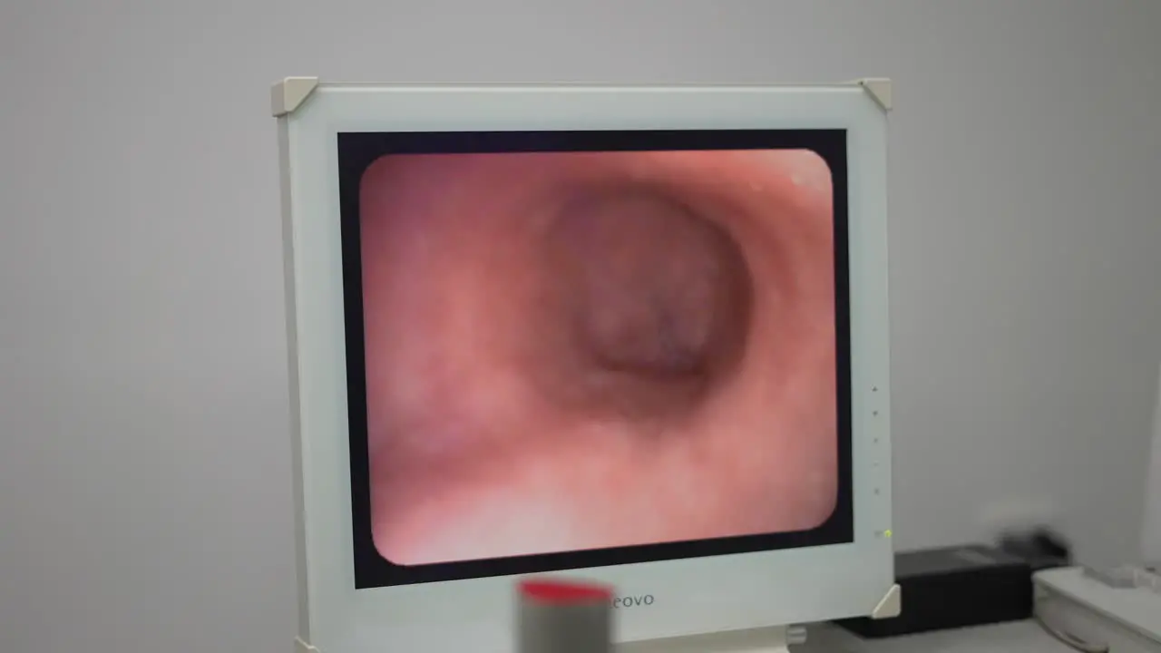 gastric balloon monitor with image of obesity operation doctor in operating room