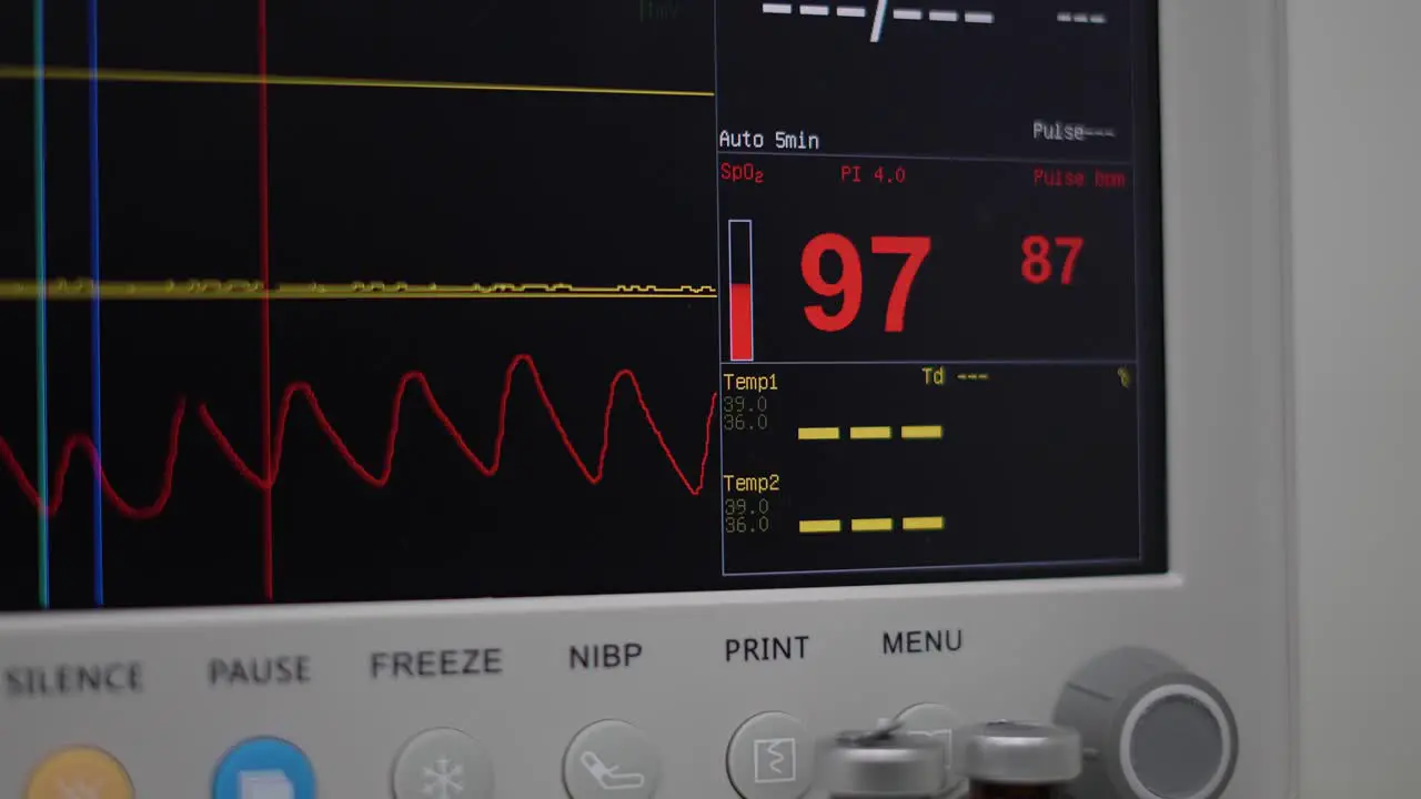 monitor in the operating room patient pulses